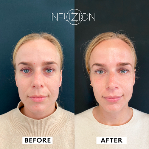 Nicestyle Infuzion System Treatment